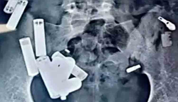 screws batteries found in boy stomach 1