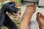 Black Snake bites women 11 times