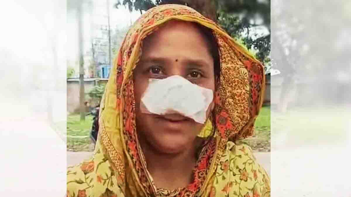 West Bengal woman injured after husband bites off nose in Shantipur incident