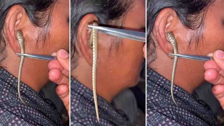 Snake inside woman’s ear during summer – viral video