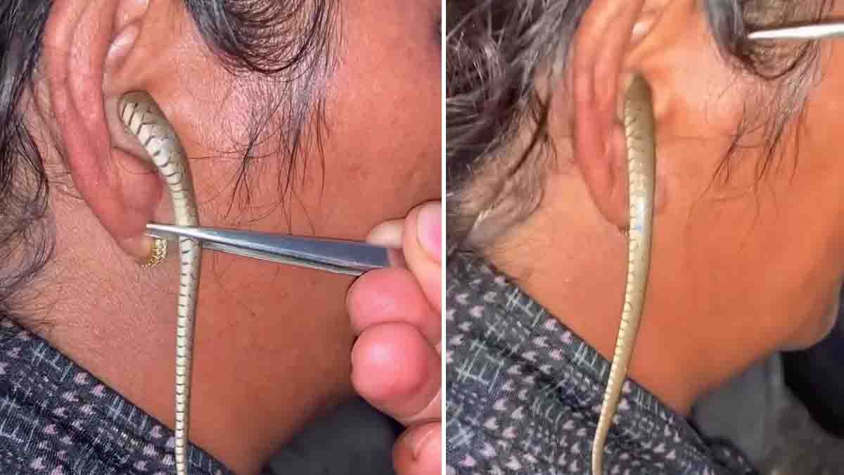 Snake inside woman’s ear during summer – viral video