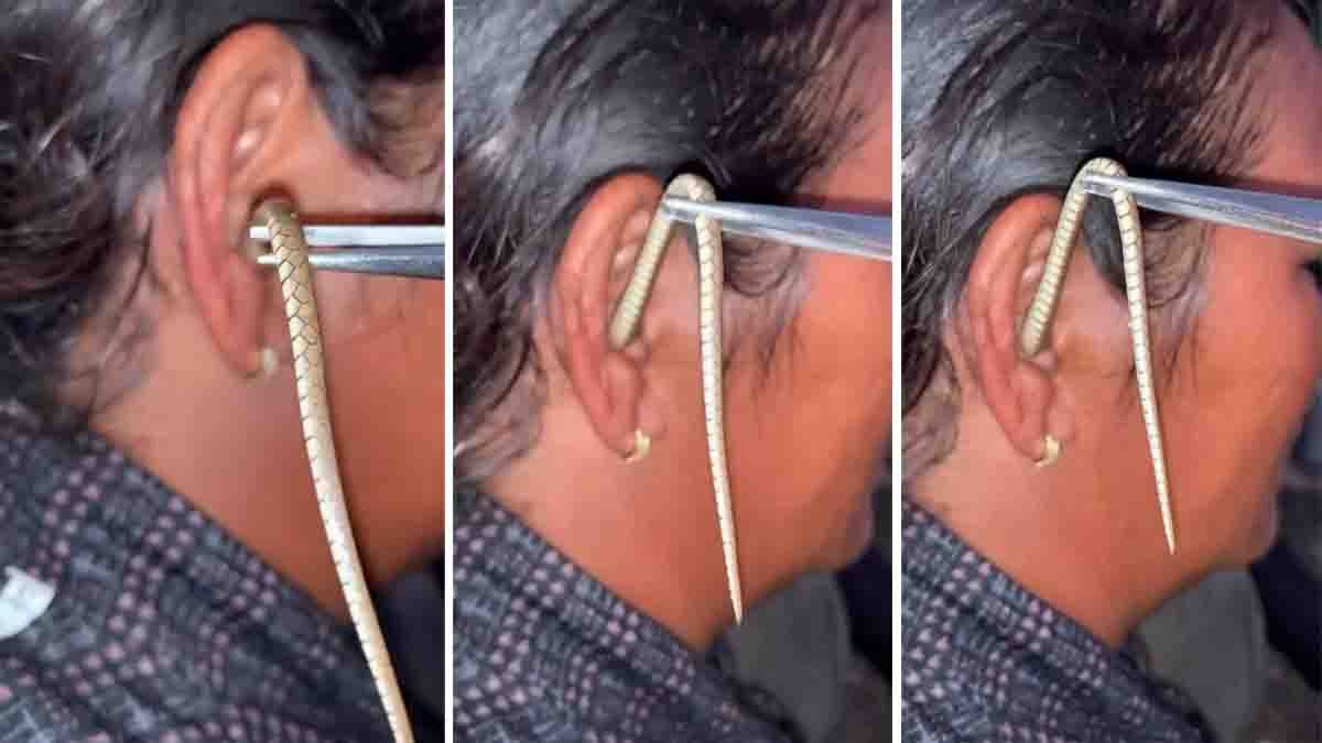 Snake inside woman’s ear during summer – viral video