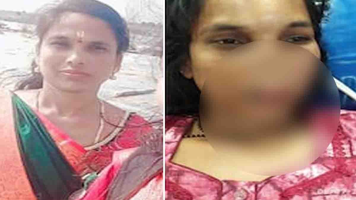 Shocking domestic violence in Davanagere – Husband bites wife's nose following a dispute over a self-help group loan installment in rural Karnataka.
