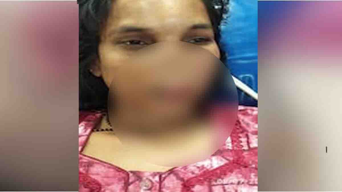 Shocking domestic violence in Davanagere – Husband bites wife's nose following a dispute over a self-help group loan installment in rural Karnataka.