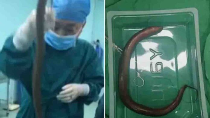 One-Foot-Long Eel Found Inside Man's Stomach in China - VIral