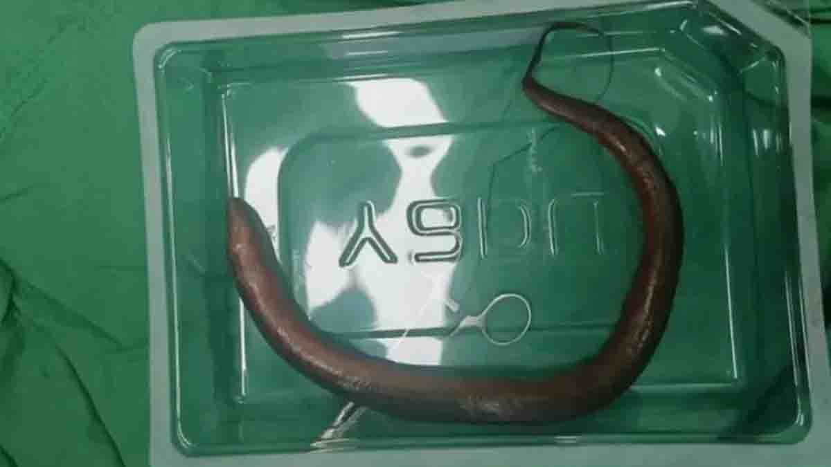 One-Foot-Long Eel Found Inside Man's Stomach in China - VIral