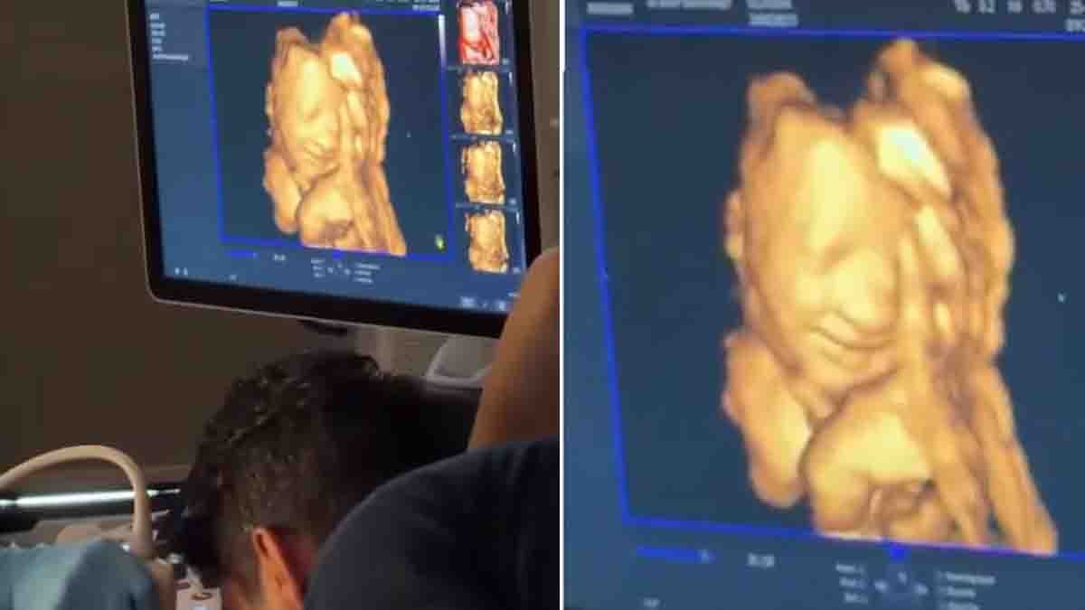 Baby Smile Viral Video showing an unborn baby smiling during an ultrasound scan after hearing the father's voice in a heartwarming moment.